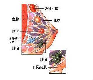 附件炎性包块