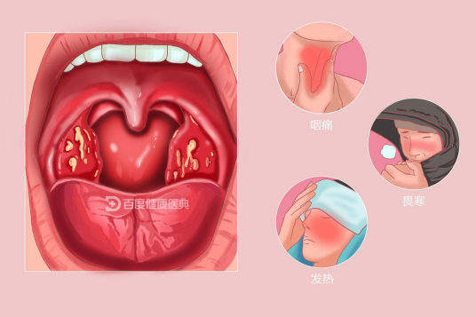 急性扁桃体炎