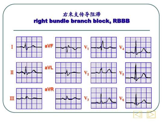 右束支传导阻滞