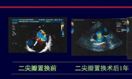 二尖瓣和三尖瓣轻度返流是什么意思？应该怎么办？