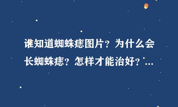 谁知道蜘蛛痣图片？为什么会长蜘蛛痣？怎样才能治好？谢谢了！