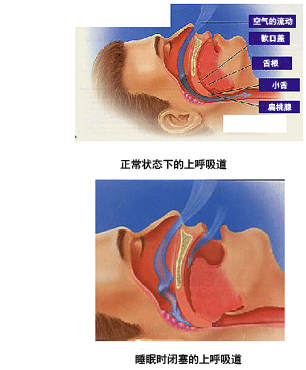 请问睡眠呼吸暂停综合征怎么治疗？