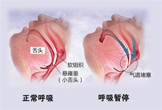 请问睡眠呼吸暂停综合征怎么治疗？