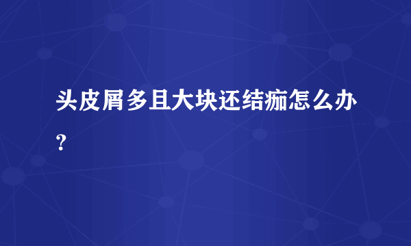 头皮屑多且大块还结痂怎么办？